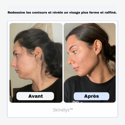 Skinélys™ – Soin facial LED nouvelle génération